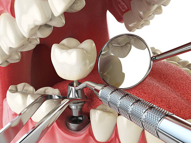Best Emergency Tooth Extraction in Putnam Lake, NY